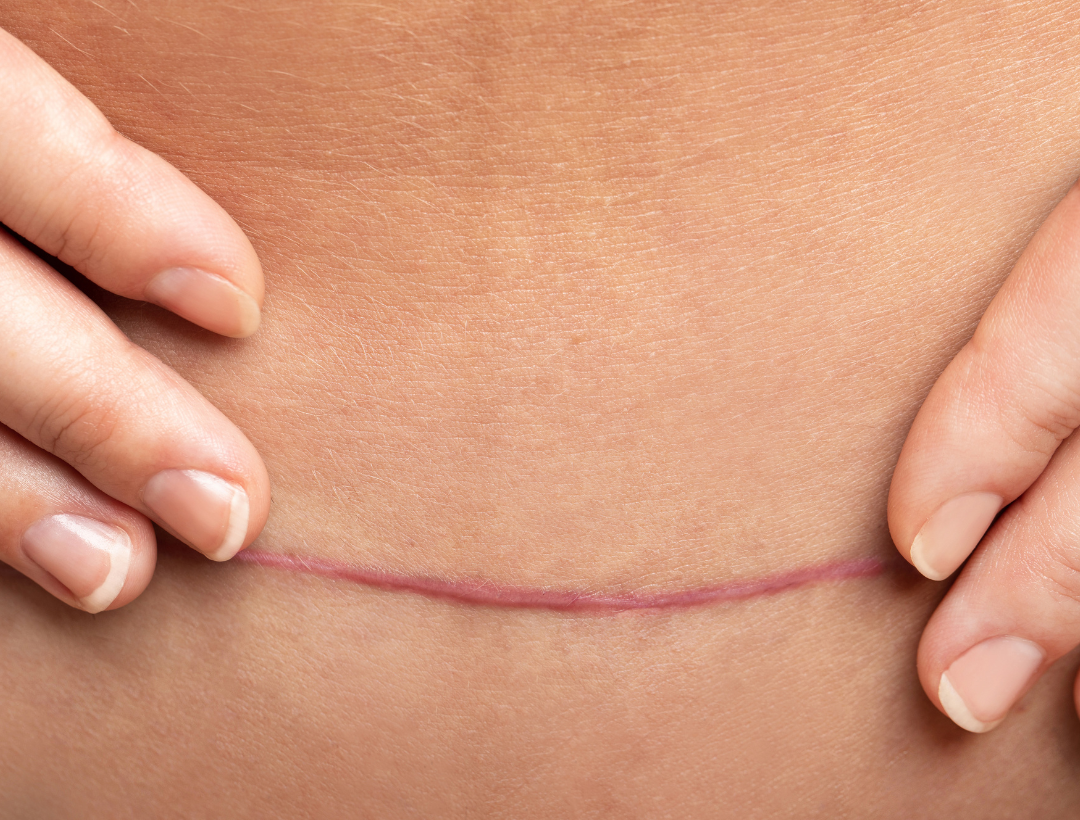 keizersnede behandeling cupping litteken na bevalling geboorte